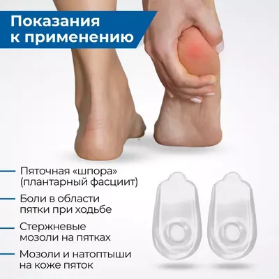 Пяточная шпора (плантарный фасциит): симптомы, причины, что делать, как  определить, как бороться