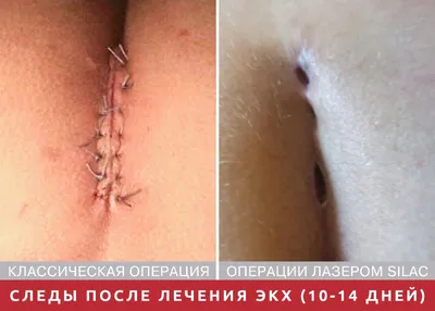 Свищ на копчике картинки фотографии