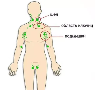 Воспаленные лимфоузлы у взрослых и лечение гомеопатией - Клиника С Ганемана