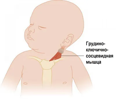 Векторная Иллюстрация Женщиной Страдающей Боли Шее Воспаление Лимфоузлов  Рисунок Векторное изображение ©vareennik 178969036